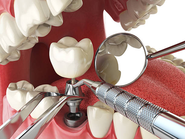Best Emergency Root Canal Treatment in Tarkio, MO